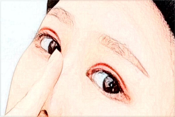 2024安徽省立醫(yī)院填充淚溝需要多少錢(qián)?醫(yī)生推薦