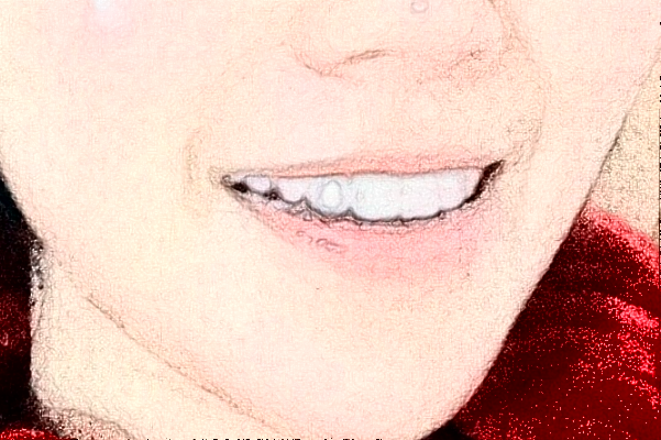 2024大慶市人民醫(yī)院口腔科根管做的好嗎?整形日記分享