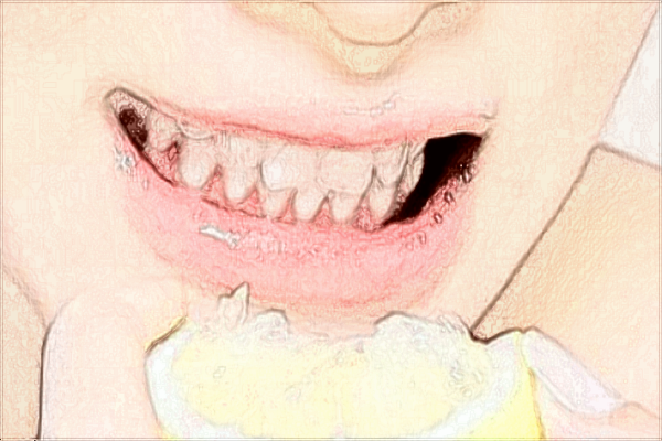 2024常德市第一人民醫(yī)院拔牙多少錢?拔牙的危害有多大