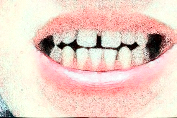 溫州醫(yī)學(xué)院附屬第二醫(yī)院口腔科補牙怎么樣_整形日記分享