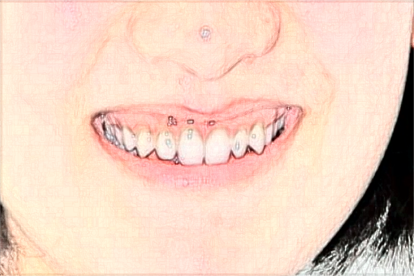 南京中大醫(yī)院牙齒矯正做的怎么樣_誰做的比較好