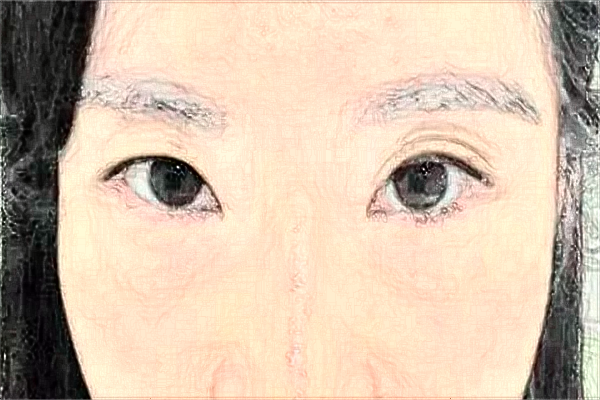 河北省人民醫(yī)院去眼袋需要多少錢?醫(yī)生推薦