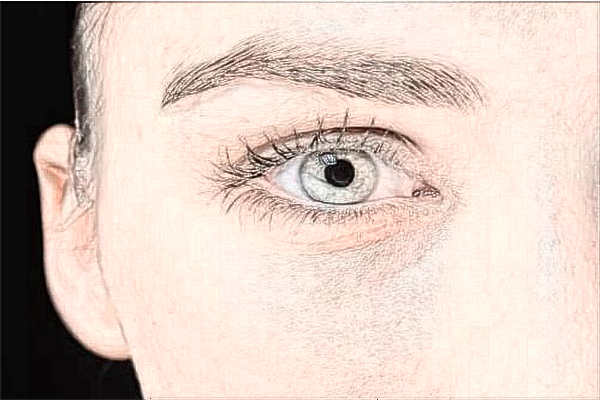 2024佛山市第二人民醫(yī)院全飛秒激光價格?全飛秒激光后遺癥