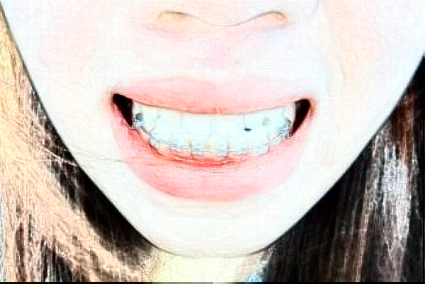 2024南京中大醫(yī)院口腔科瓷貼面做的怎么樣_誰做的比較好