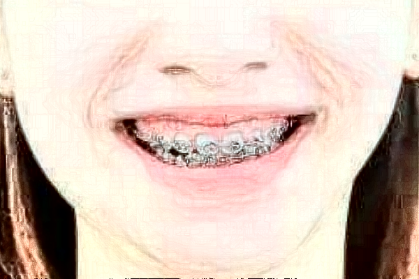 蘇北人民醫(yī)院牙齒美白價目表_口碑怎么樣