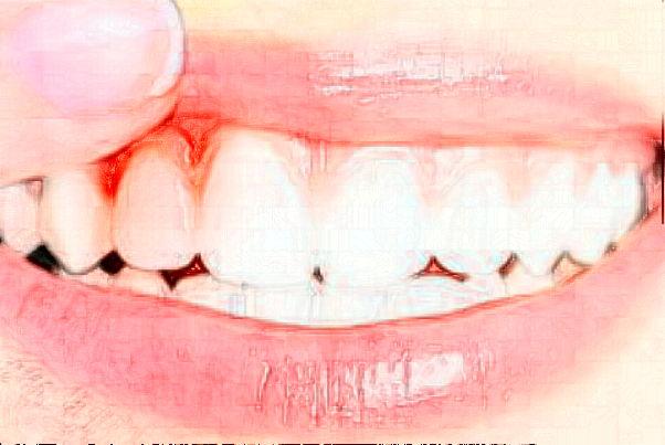 2024大連大學(xué)附屬新華醫(yī)院隱形義齒好不好?體驗(yàn)日記反饋