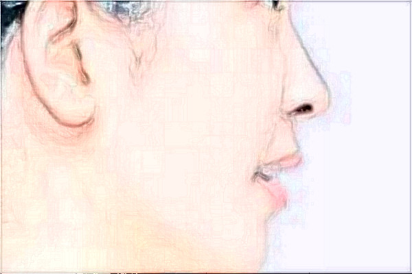 2024安徽省立醫(yī)院隆鼻怎么樣_誰(shuí)做得好