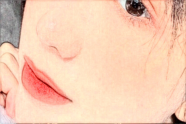 南京中大醫(yī)院激光去紅血絲怎么樣_整形日記分享