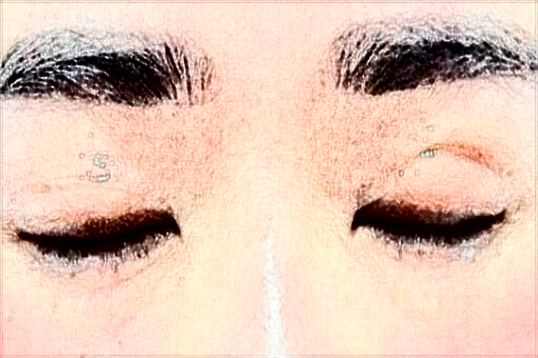 安徽醫(yī)科大學(xué)第一附屬醫(yī)院做雙眼皮價(jià)目表(價(jià)格表)怎么樣