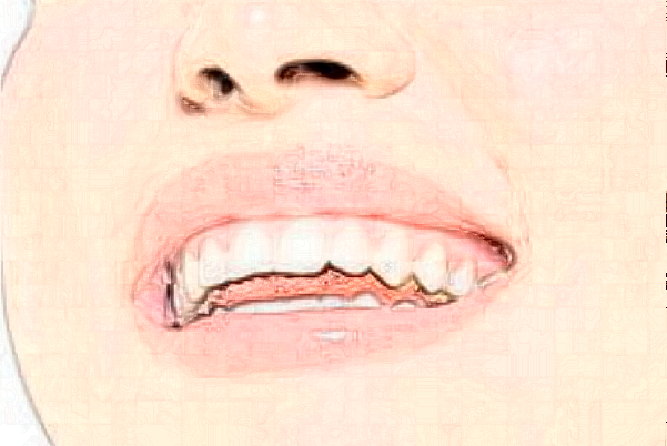 2024蘇北人民醫(yī)院義齒修復(fù)價目表_口碑怎么樣