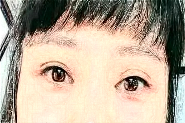 2024株洲市中心醫(yī)院雙眼皮手術收費價格?割雙眼皮好嗎