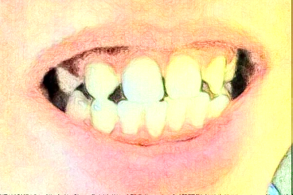 2024安徽醫(yī)科大學第一附屬醫(yī)院種牙多少錢【種牙案例】