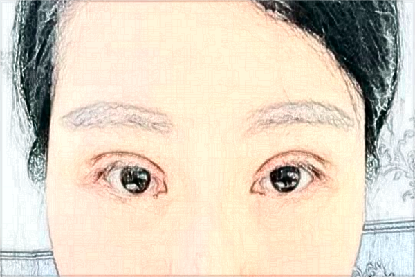 2024沈陽(yáng)盛京醫(yī)院割雙眼皮醫(yī)生名單_案例分享