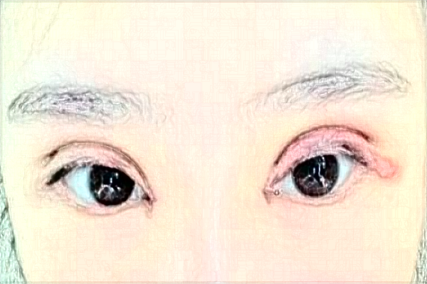 2024沈陽(yáng)盛京醫(yī)院割雙眼皮醫(yī)生名單_案例分享