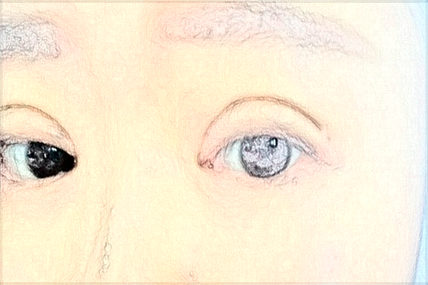 南通大學(xué)附屬醫(yī)院割雙眼皮價(jià)目表(價(jià)格表)怎么樣