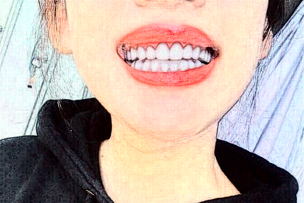 上海華美醫(yī)療美容醫(yī)院樹(shù)脂補(bǔ)牙價(jià)目(價(jià)格)表_怎么樣