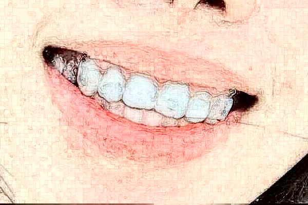 長(zhǎng)沙科爾雅口腔醫(yī)院洗牙價(jià)格(價(jià)目)_案例_