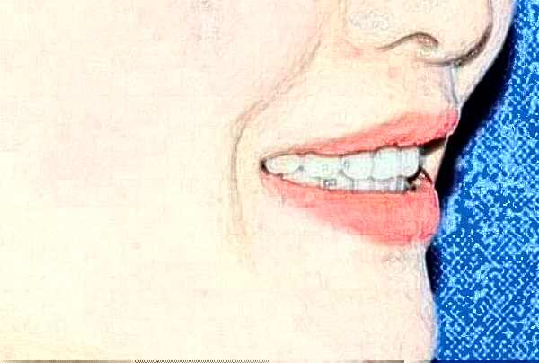 鄭州唯美口腔醫(yī)院地包天矯正費(fèi)用多少_醫(yī)生名單