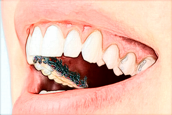 2024株洲市中心醫(yī)院根管要多少錢(qián)?根管推薦醫(yī)生