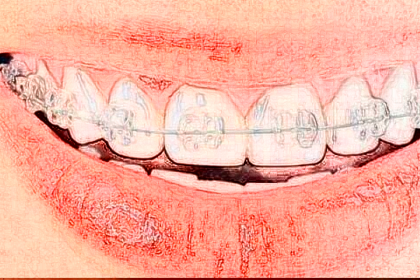 2024株洲市中心醫(yī)院矯正牙齒多少錢(qián)?矯正牙齒貴嗎