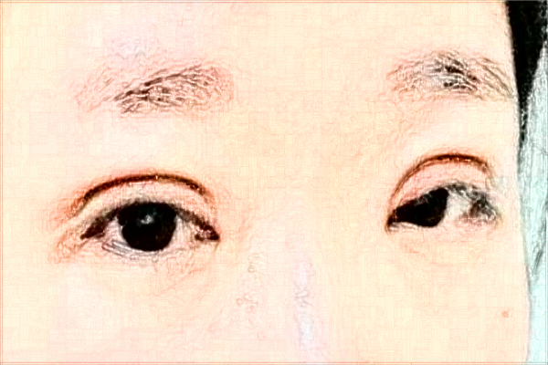 2024懷化市第一人民醫(yī)院飛秒價格?飛秒激光好不好?