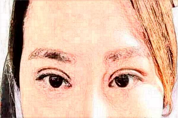 煙臺毓璜頂醫(yī)院整形美容科誰做鼻子做得好?隆鼻案例