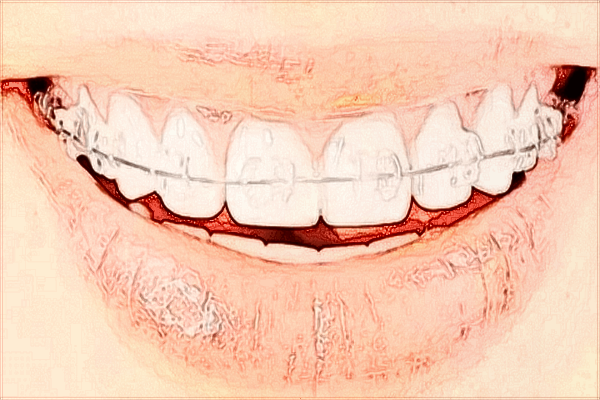 2024?？谑腥嗣襻t(yī)院牙齒矯正費(fèi)用?牙齒矯正醫(yī)生技術(shù)好嗎