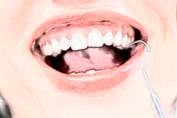 安徽醫(yī)科大學(xué)第一附屬醫(yī)院種植義齒怎么樣_整形日記分享