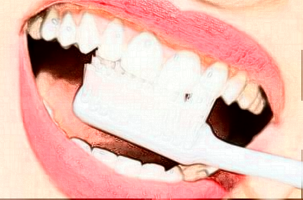 安徽醫(yī)科大學(xué)第一附屬醫(yī)院種植義齒怎么樣_整形日記分享