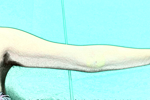 南京鼓樓醫(yī)院吸脂怎么樣_體驗(yàn)日記分享