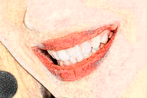 長(zhǎng)沙科爾雅口腔醫(yī)院隱形正畸收費(fèi)標(biāo)準(zhǔn),案例變化分享