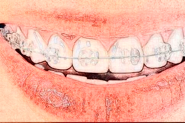 2024山東省千佛山醫(yī)院拔牙費(fèi)用?拔牙后有什么注意事項(xiàng)