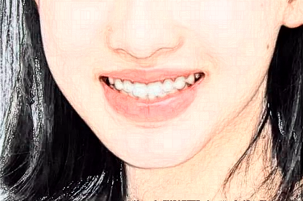 懷化市第一人民醫(yī)院牙齒矯正怎么樣?牙齒矯正有幾種方式