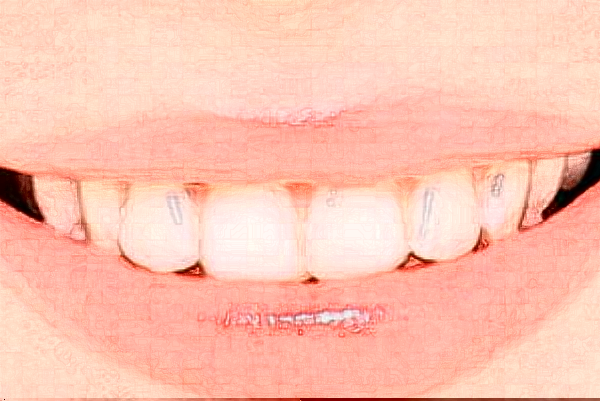 長沙好大夫口腔醫(yī)院牙齒美容怎么樣_體驗日記分享