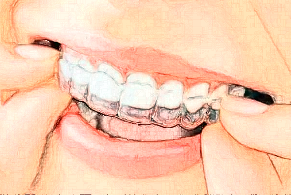 2024無(wú)錫市人民醫(yī)院烤瓷牙好嗎?附價(jià)格表+案例