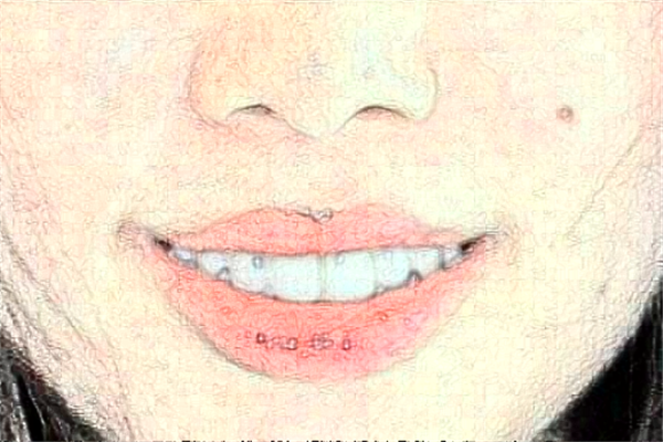 安徽醫(yī)科大學第一附屬醫(yī)院正畸做的好嗎?哪位醫(yī)生做得