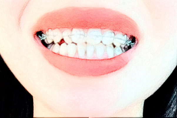 成都新橋口腔醫(yī)院種植牙技術(shù)如何?種植牙后遺癥