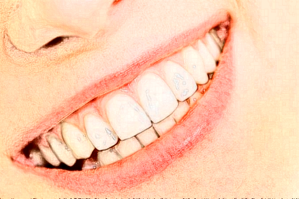 2024天津南開(kāi)醫(yī)院牙齒美白怎么樣_整形日記分享