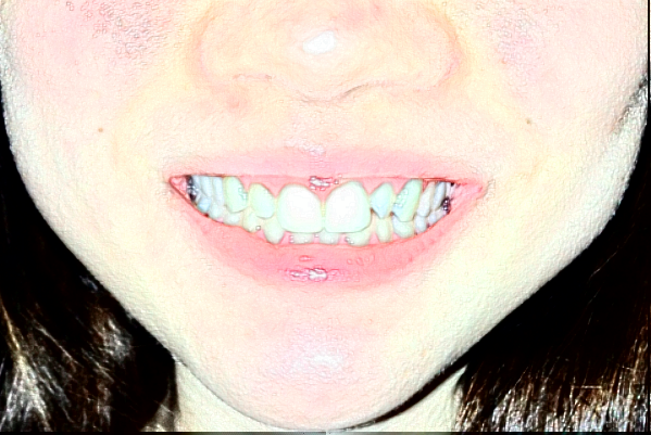 鄭州植得口腔醫(yī)院瓷貼面牙齒有危害嗎?2024瓷貼面價格