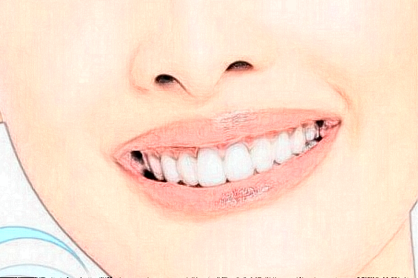 2024中山香山口腔醫(yī)院價(jià)格表?超聲波洗牙怎么樣