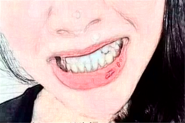 成都茁悅口腔種植牙好嗎_真實(shí)案例發(fā)布