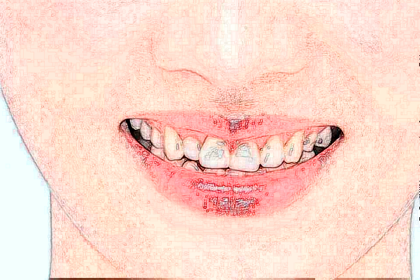 2024中山香山口腔醫(yī)院超聲波洗牙多少錢?超聲波洗牙的危害