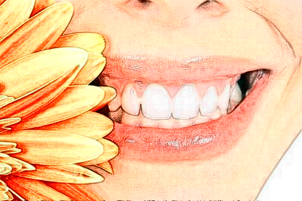 2024中山香山口腔醫(yī)院瓷貼面多少錢?瓷貼面牙齒有危害嗎