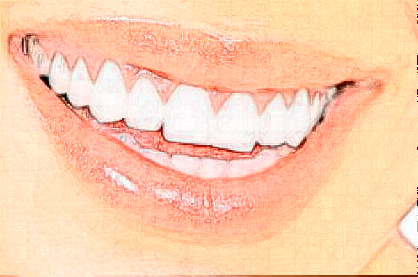 福州福能海峽口腔醫(yī)院冷光美白多少錢_案例反饋