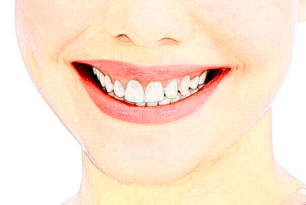 2024杭州植得口腔門診部地包天矯正做的好嗎