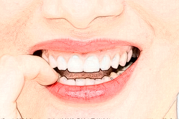 長(zhǎng)沙科爾雅口腔醫(yī)院?jiǎn)窝婪N植價(jià)格多少?整形日記全過程分享