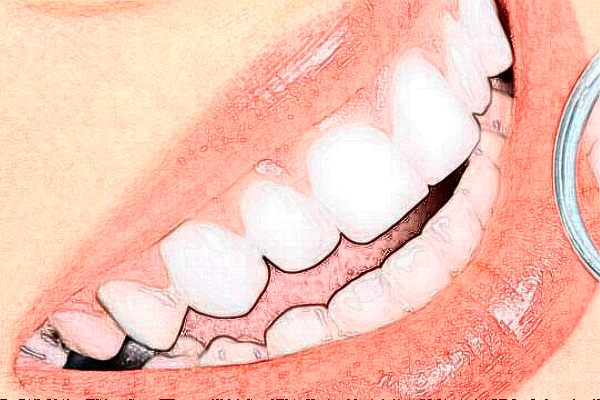 上海華美醫(yī)療美容醫(yī)院根管價目(價格)表_怎么樣