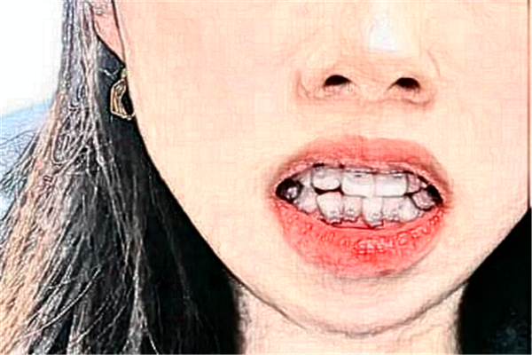 長沙科爾雅口腔醫(yī)院半口種植案例_專家介紹