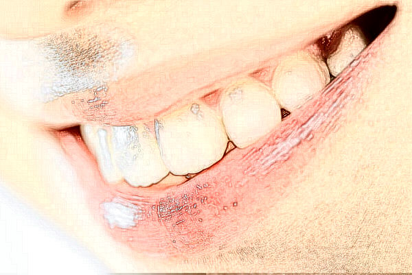 2024贛州貝殼口腔種植牙怎么樣?貴,但是值得!