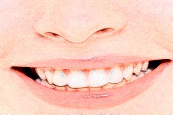 鄭州唯美口腔醫(yī)院美容冠價(jià)格多少?整形日記全過程分享